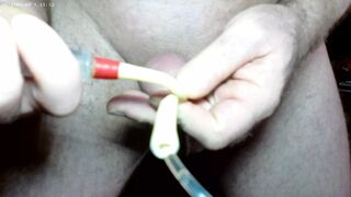 18Fr Catheter insertion - 1 image